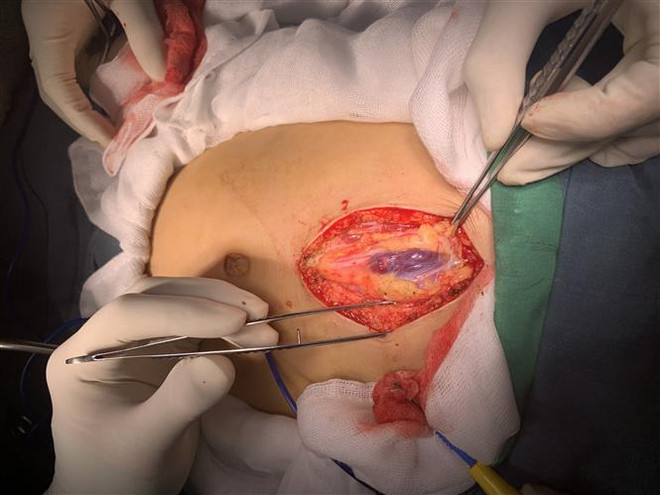 Cần Thơ: Cứu sống kịp thời bệnh nhi bị vỡ lách do tai nạn sinh hoạt ảnh 1