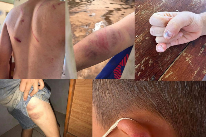 Đắk Lắk: Xác minh, điều tra làm rõ vụ việc cháu bé 9 tuổi bị đánh đập ảnh 1