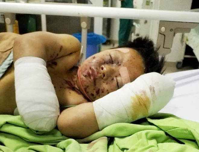 Đắk Lắk: Xác minh nguyên nhân vụ nổ làm hai bé trai bị thương ảnh 2