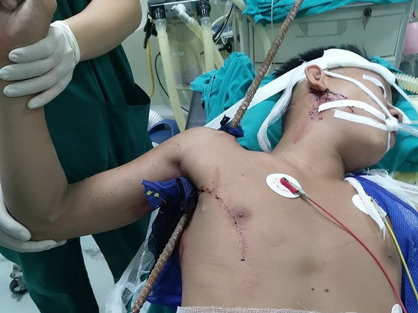 Bệnh nhân sau ca phẫu thuật cấp cứu. (Ảnh: TTXVN phát) Cấp cứu thành công người bị thanh sắt đâm xuyên thấu từ nách lên vai ảnh 1