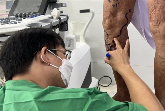 Bệnh viện Đà Nẵng triển khai kỹ thuật mới điều trị suy giãn tĩnh mạch ảnh 1