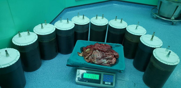 TP.HCM: Phẫu thuật lấy khối u buồng trứng lớn hiếm thấy ảnh 2