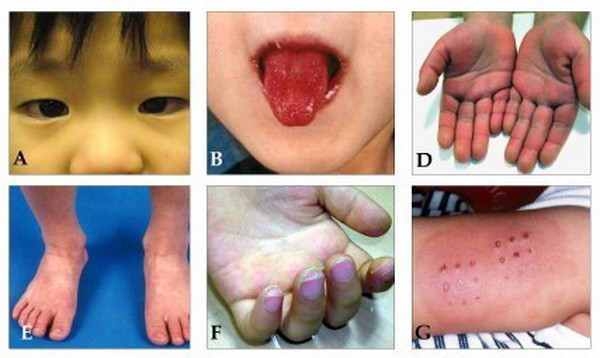 Bé 3 tháng tuổi mắc bệnh Kawasaki hiếm gặp may mắn cấp cứu kịp ảnh 1