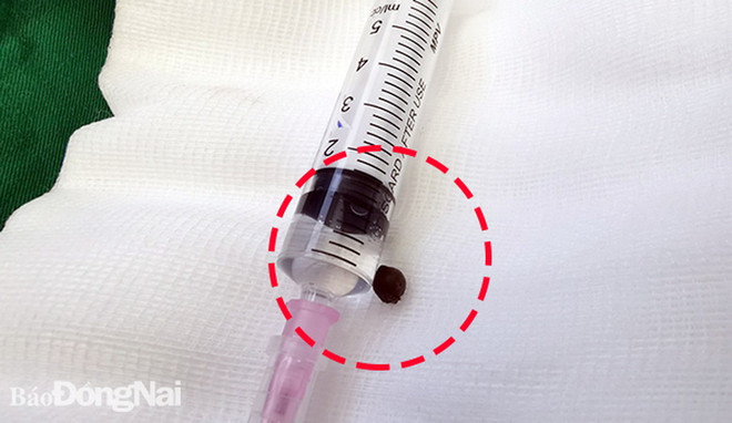 Gắp thành công dị vật nằm trên đỉnh phổi bệnh nhân suốt 7 năm ảnh 1