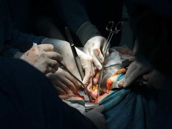 Bệnh viện Bạch Long Vĩ cứu sống bệnh nhân viêm ruột thừa hóa mủ ảnh 1