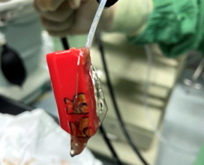 Nội soi gắp thành công chiếc bật lửa gas khỏi dạ dày của 1 thanh niên ảnh 1