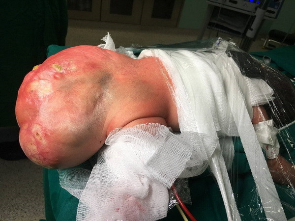 Bóc tách thành công khối u quái khổng lồ ở trẻ sơ sinh ảnh 1