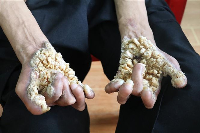 Ghi nhận trường hợp 'người cây' đầu tiên tại Việt Nam ảnh 1