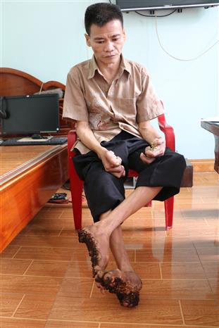 Ghi nhận trường hợp 'người cây' đầu tiên tại Việt Nam ảnh 2