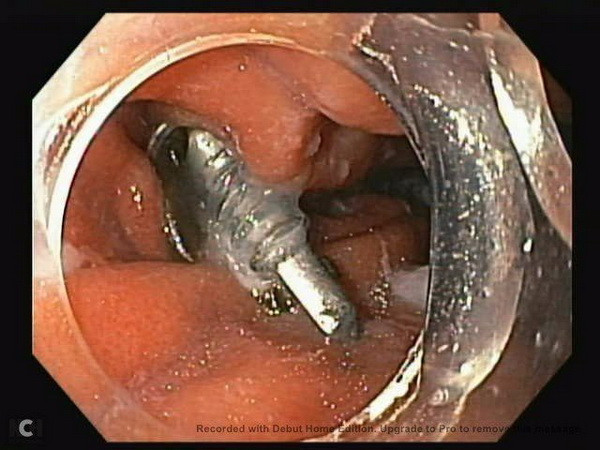 Phú Thọ: Cấp cứu thành công bé trai nuốt phải cây đinh vít nhọn ảnh 1
