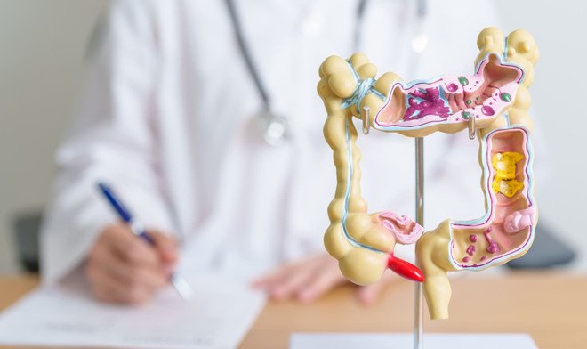 ung thu dai trang2.jpg