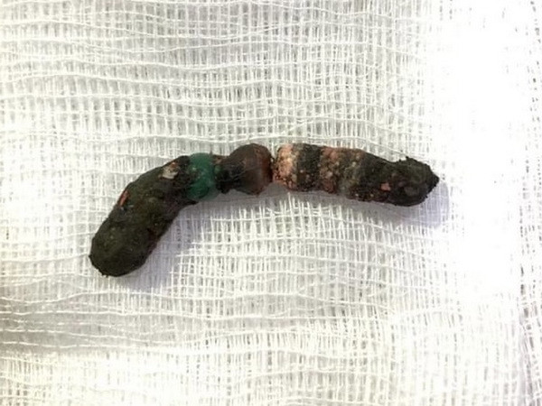 Cứu kịp thời bé gái bị thủng ruột do nuốt bi nam châm đồ chơi ảnh 1