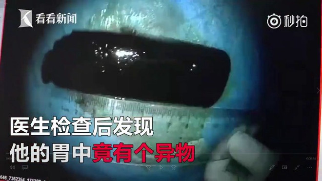 Đi khám bệnh bất ngờ phát hiện bật lửa nằm trong dạ dày suốt 20 năm ảnh 1