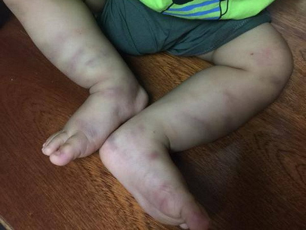 Khởi tố vụ án bé trai 1 tuổi nghi bị bạo hành, gây thương tích ảnh 1