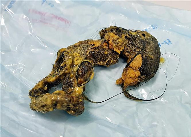 Bé gái 4 tuổi bị tắc hoàn toàn ruột non do thói quen nuốt tóc ảnh 1