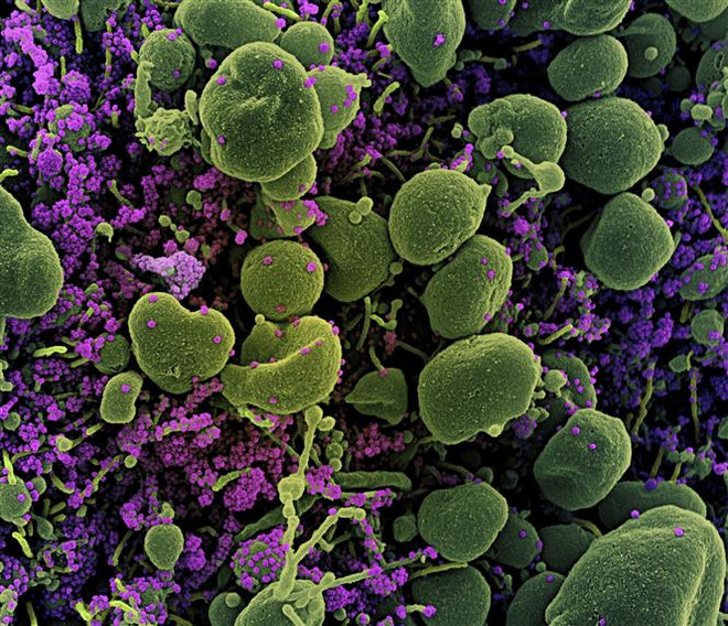 Hình ảnh quét qua kính hiển vi điện tử cho thấy tế bào (màu xanh) bị virus SARS-COV-2 (màu tím) xâm nhập. (Ảnh: AFP/TTXVN) Nhật Bản tiến hành phân tích biến thể mới của virus SARS-CoV-2 ảnh 1
