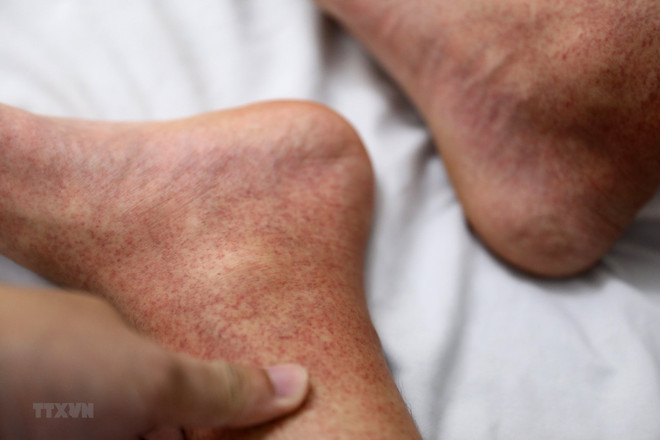 Hà Nội: Hiện vẫn còn 239 ổ dịch sốt xuất huyết vẫn đang hoạt động ảnh 2