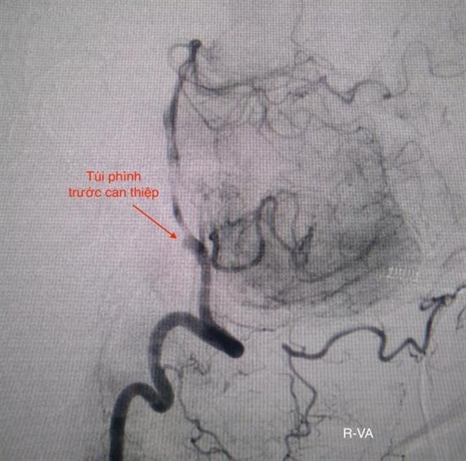 Cứu sống bệnh nhân hai lần ngưng tim do vỡ túi phình mạch máu não ảnh 2