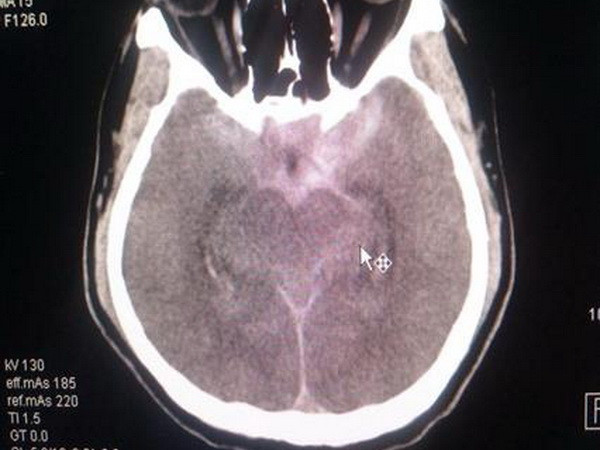 Cứu sống bệnh nhân hai lần ngưng tim do vỡ túi phình mạch máu não ảnh 1