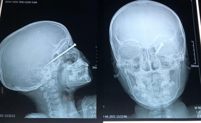 Đi bắt chuột rạng sáng, bé trai 8 tuổi bị bạn bắn trúng mắt trái ảnh 1