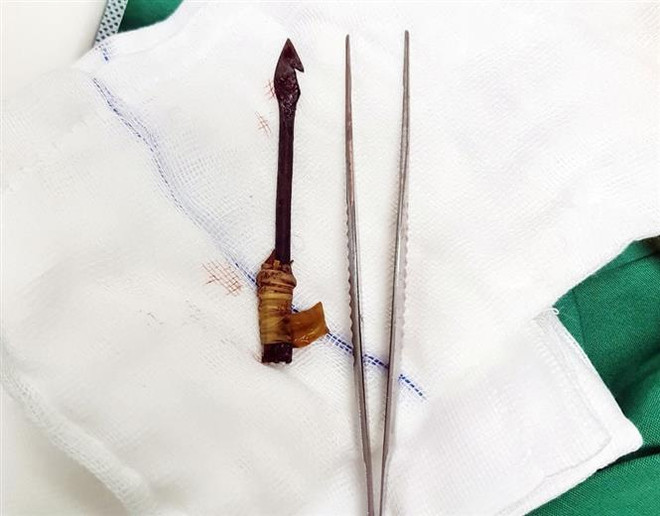 Đi bắt chuột rạng sáng, bé trai 8 tuổi bị bạn bắn trúng mắt trái ảnh 2