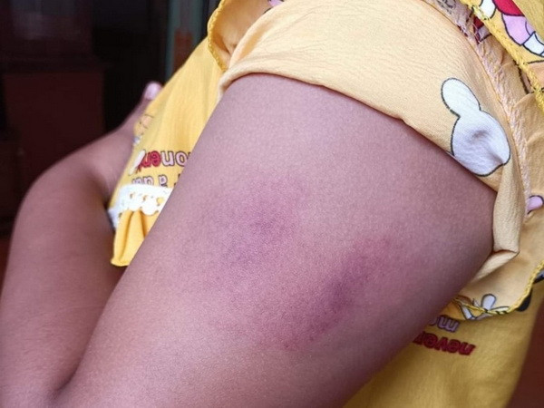 Đắk Lắk: Xem xét xử lý trường hợp giáo viên đánh học sinh lớp 1 ảnh 1