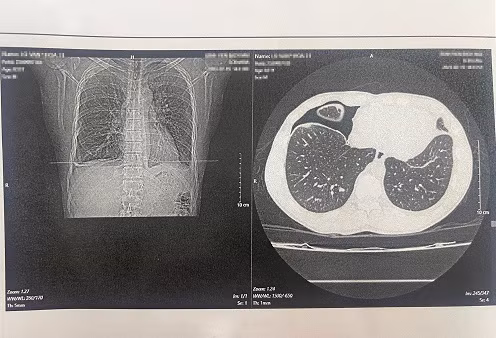Ăn món gỏi cua sống, một nam thanh niên bị nhiễm “sán lá phổi” ảnh 2