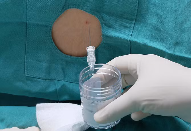 Bệnh nhi bị viêm màng não do nhiễm giun đũa từ chó, mèo ảnh 1