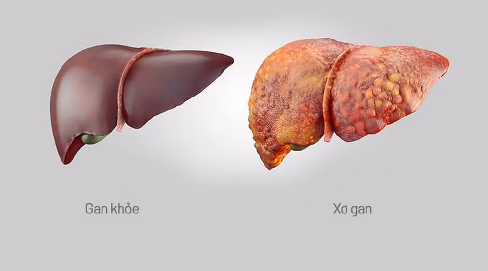 xo-gan-la-benh-gi.jpg