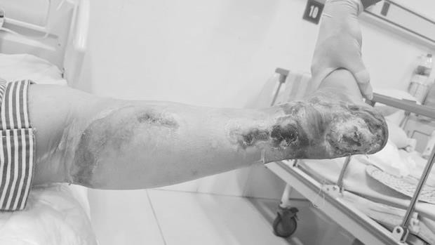 Nữ bệnh nhân phải cắt cụt chân vì biến chứng của đái tháo đường ảnh 1