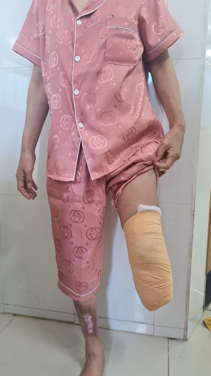Nữ bệnh nhân phải cắt cụt chân vì biến chứng của đái tháo đường ảnh 2