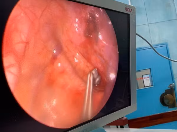 Phẫu thuật nội soi lấy viên đạn ra khỏi lồng ngực bé trai 6 tuổi ảnh 1
