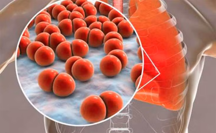 Cuba nghiên cứu phát triển vaccine chống lại phế cầu khuẩn ảnh 1