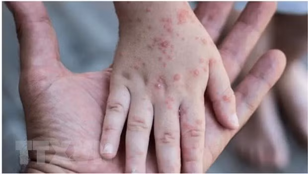 Tăng cường năng lực chẩn đoán, sẵn sàng ứng phó bệnh đậu mùa khỉ ảnh 3