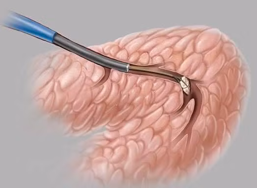 Phương pháp mới trong chẩn đoán và điều trị bệnh lý tuyến nước bọt ảnh 1