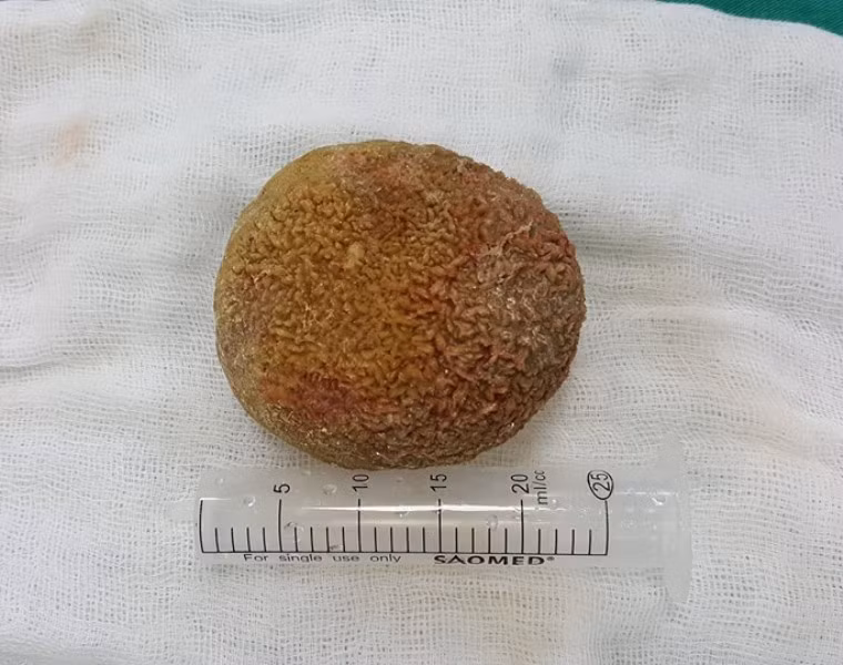 Cắt bỏ viên sỏi thận nặng 0,5kg trong bụng một bệnh nhân ảnh 1