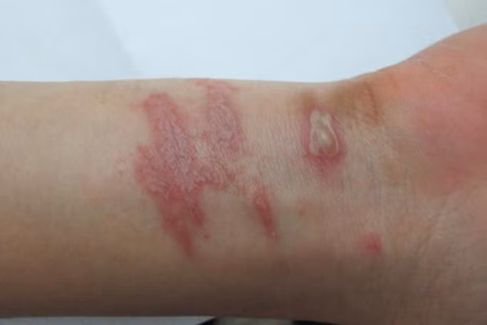 Hà Nội: Số người viêm da nặng do tiếp xúc với kiến ba khoang tăng mạnh ảnh 1