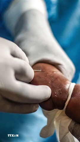 Nhân viên y tế điều trị cho bệnh nhân mắc đậu mùa khỉ. (Ảnh: THX/TTXVN)