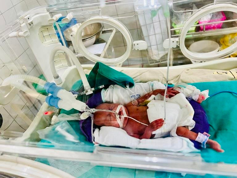 Bé An Chi trong thời gian nằm lồng ấp, chỉ nhỏ xíu như chú chuột Hamster, xung quanh là máy móc, dây chuyền chằng chịt. (Ảnh: PV/Vietnam+)