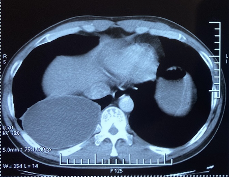 Tổn thương trên phim cắt lớp vi tính lồng ngực của bệnh nhân. (Ảnh: PV/Vietnam+)