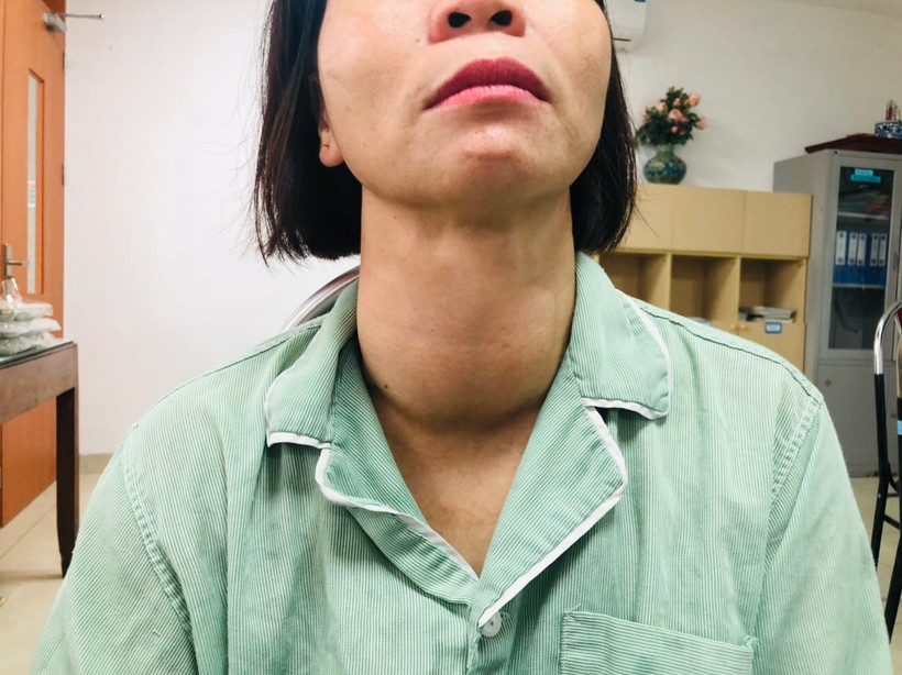 Khối u "khổng lồ" trên cổ bệnh nhân. (Ảnh: PV/Vietnam+)