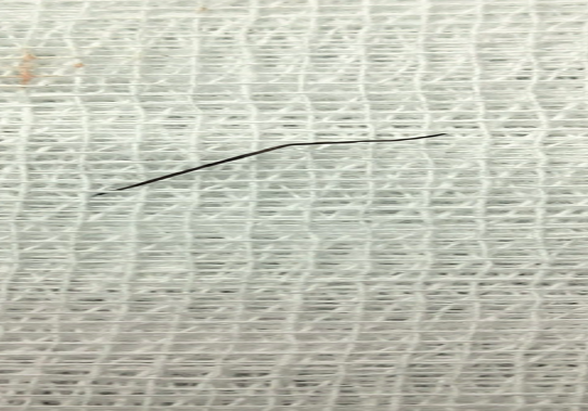 Dị vật được các bác sĩ lấy ra từ trong bụng của bệnh nhân. (Ảnh: PV/Vietnam+)