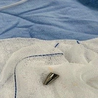 Dị vật là đầu ngòi bút, bề dày thành khoảng 1,8mm, chiều dài khoảng 18mm. (Nguồn: Bệnh viện Phụ sản-Nhi Đà Nẵng)