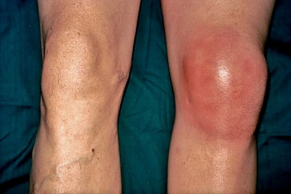 Áp Dụng Phương Pháp Dân Gian Chữa Gout, Người Đàn Ông Đối Mặt Nguy Cơ Tàn Phế