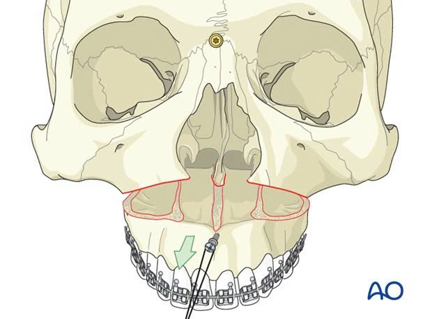 បច្ចេកទេស osteotomy Maxillary យោងតាមបន្ទាត់ Le Fort I ។ dieu-tri-mom-3.jpg