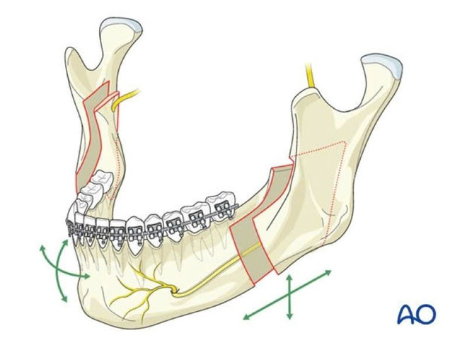 បច្ចេកទេស BSSO mandibular osteotomy ។ dieu-tri-mom-2.jpg