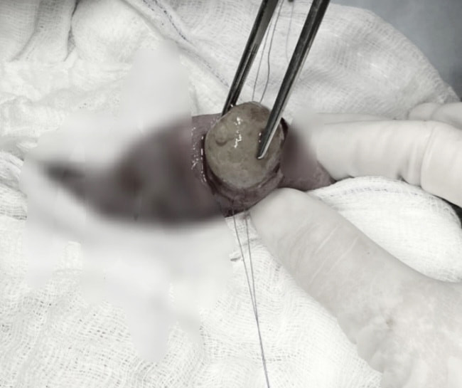 Bé gái 13 tháng tuổi tắc ruột, phải mổ gấp vì nuốt phải hạt nở ảnh 1