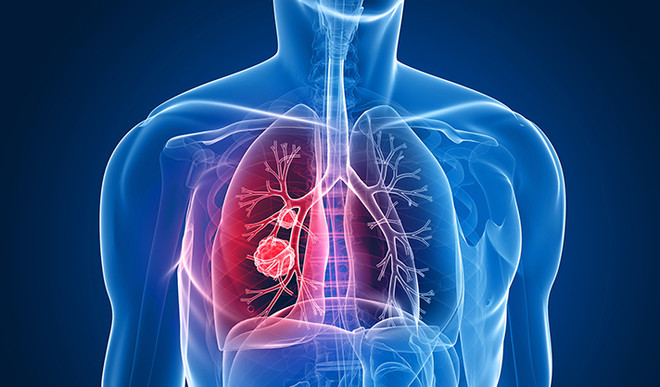 Phần lớn bệnh nhân ung thư ở Anh có thể sống thêm 10 năm ảnh 1