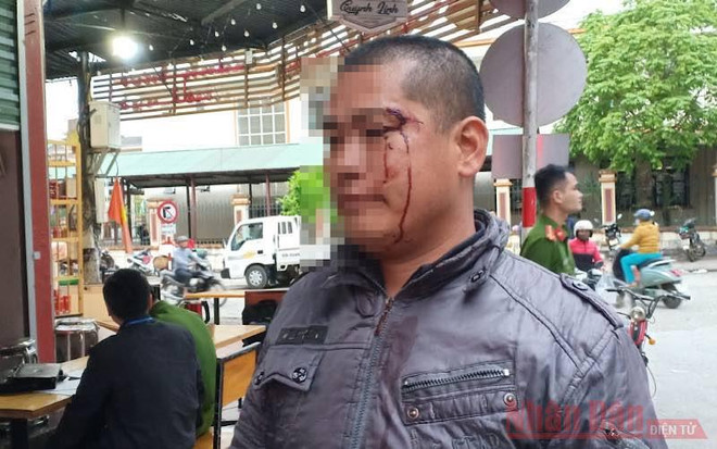 Anh Triệu La Luyện bị đánh gây thương tích, chảy máu vùng mặt. (Nguồn: Báo Nhân Dân) Đình chỉ công tác 4 cán bộ liên quan tới vụ xô xát với người dân ảnh 1