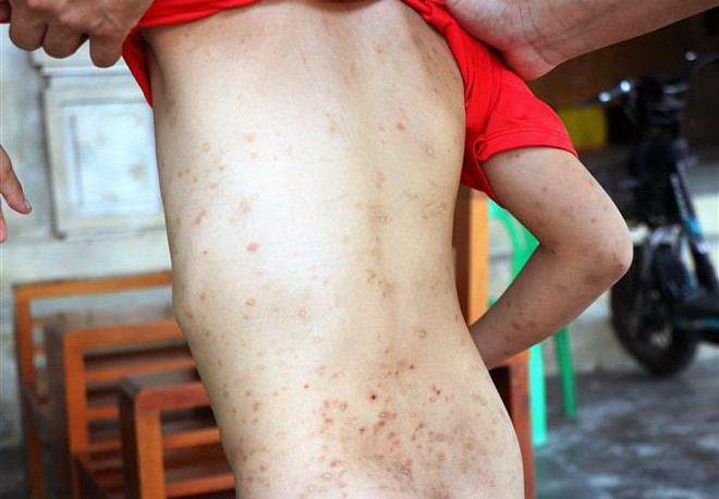 Hà Tĩnh: Ngăn chặn tình trạng người dân bị bọ chét cắn, gây mẩn ngứa ảnh 1